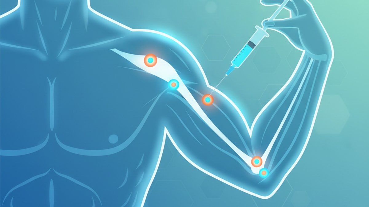 Blog Post: where to inject bpc 157 for bicep tendonitis - Professional illustration